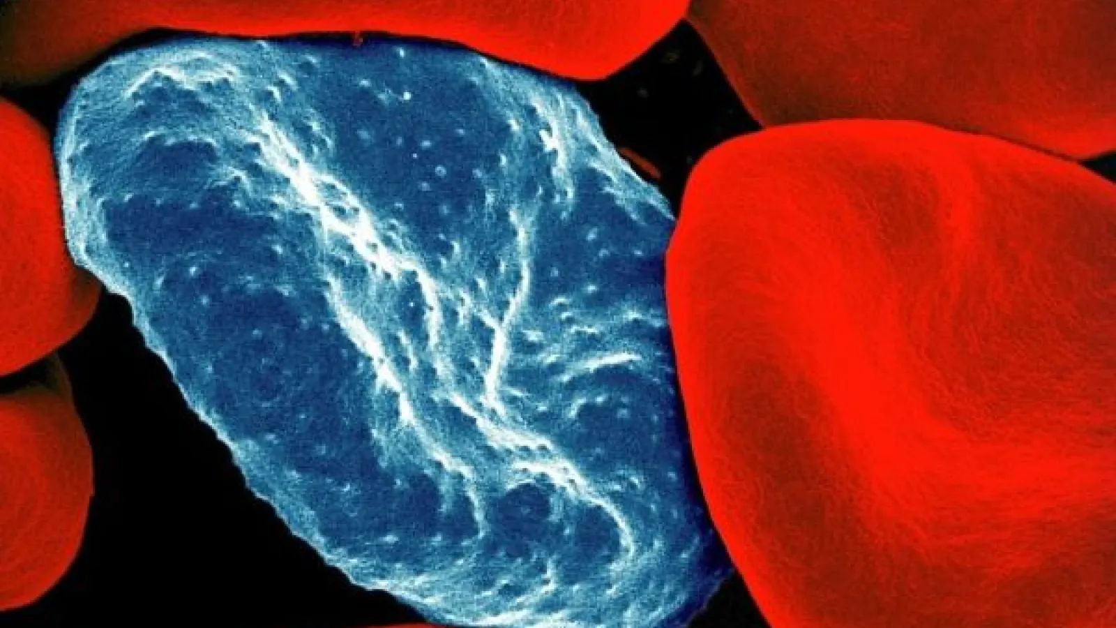 Colorized scanning electron micrograph of a red blood cell infected with malaria parasites