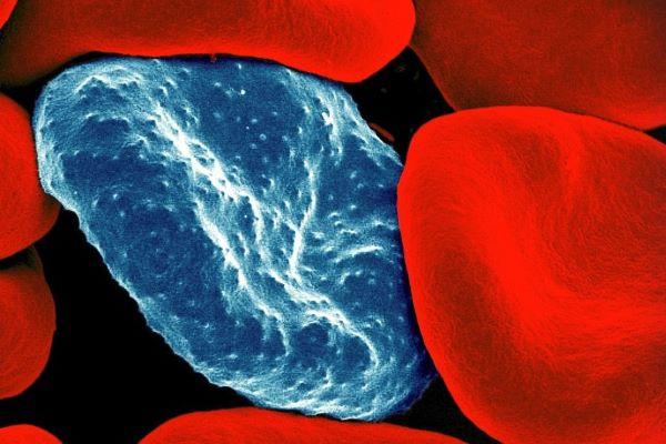 Colorized scanning electron micrograph of a red blood cell infected with malaria parasites